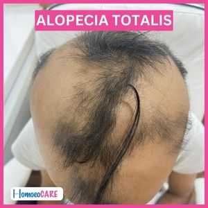 Girl Suffering from Alopecia Totalis: An image depicting a young girl experiencing Alopecia Totalis